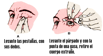 Cuerpo Extaño en el Ojo