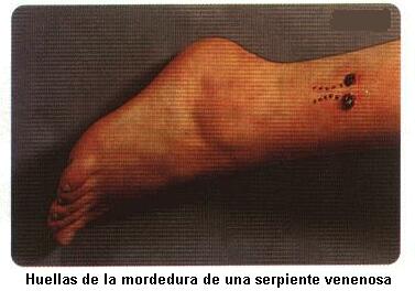 Mordedura de una Serpiente Venenosa
