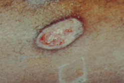 Úlcera producida por leishmaniasis