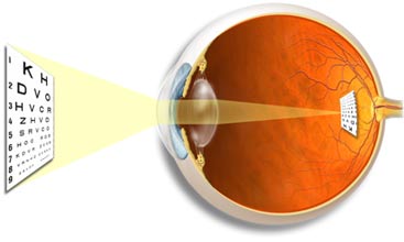 En la miopía la imagen se forma antes de llegar la luz a la retina. Tomada de www.stlukeseye.com