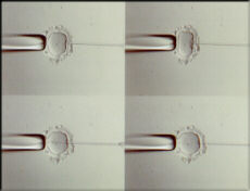 Inyeccin de espermatozoide en un vulo