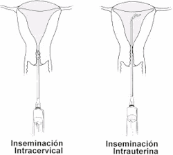 Inseminacin artificial