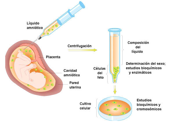 La amniocentesis permite detectar gran número de anomalías genéticas, ya que analiza directamente los cromosomas del feto. Adaptada de fig.cox.miami.edu